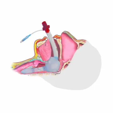 The Ambu King LTS-D Laryngeal Tube Set for Adult, Size 4, is a disposable, user-friendly airway device designed for superior patient ventilation and minimal risk of tracheal entry, featuring a separate channel for gastric tube passage and a beveled distal tip for precise placement.