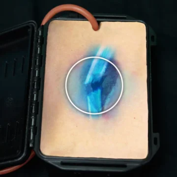 The Shrapnel Wound in a Box® is a compact, realistic task trainer for teaching wound packing techniques in soft-tissue trauma with internal bone fracture simulation. Constructed from durable silicone with integrated blood tubing, it supports pressure-responsive bleeding when connected to a compatible system. - SÅR-PTT-B03