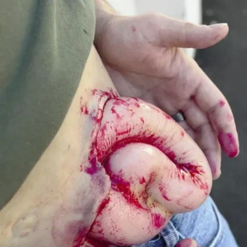 The Deluxe Moulage Kit by Techline Trauma is a comprehensive, portable trauma simulation set featuring ten high-fidelity wound models and an integrated bleeding system. Designed for real-world training, it supports diverse trauma scenarios for paramedics, emergency responders, and military personnel. - SÅR-WW3-000