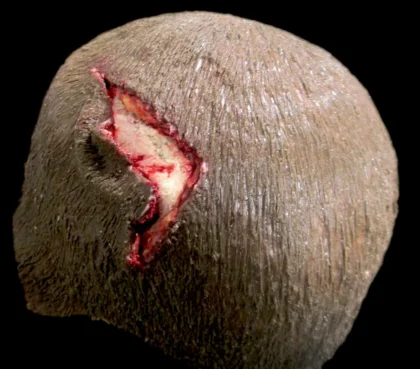 Open Wound - Scalp - Image 3