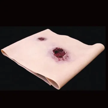 Gunshot wound (GSW) Leg