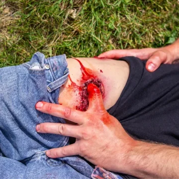 Gunshot wound (GSW) Leg 5 Gunshot wound (GSW) Leg - Image 3