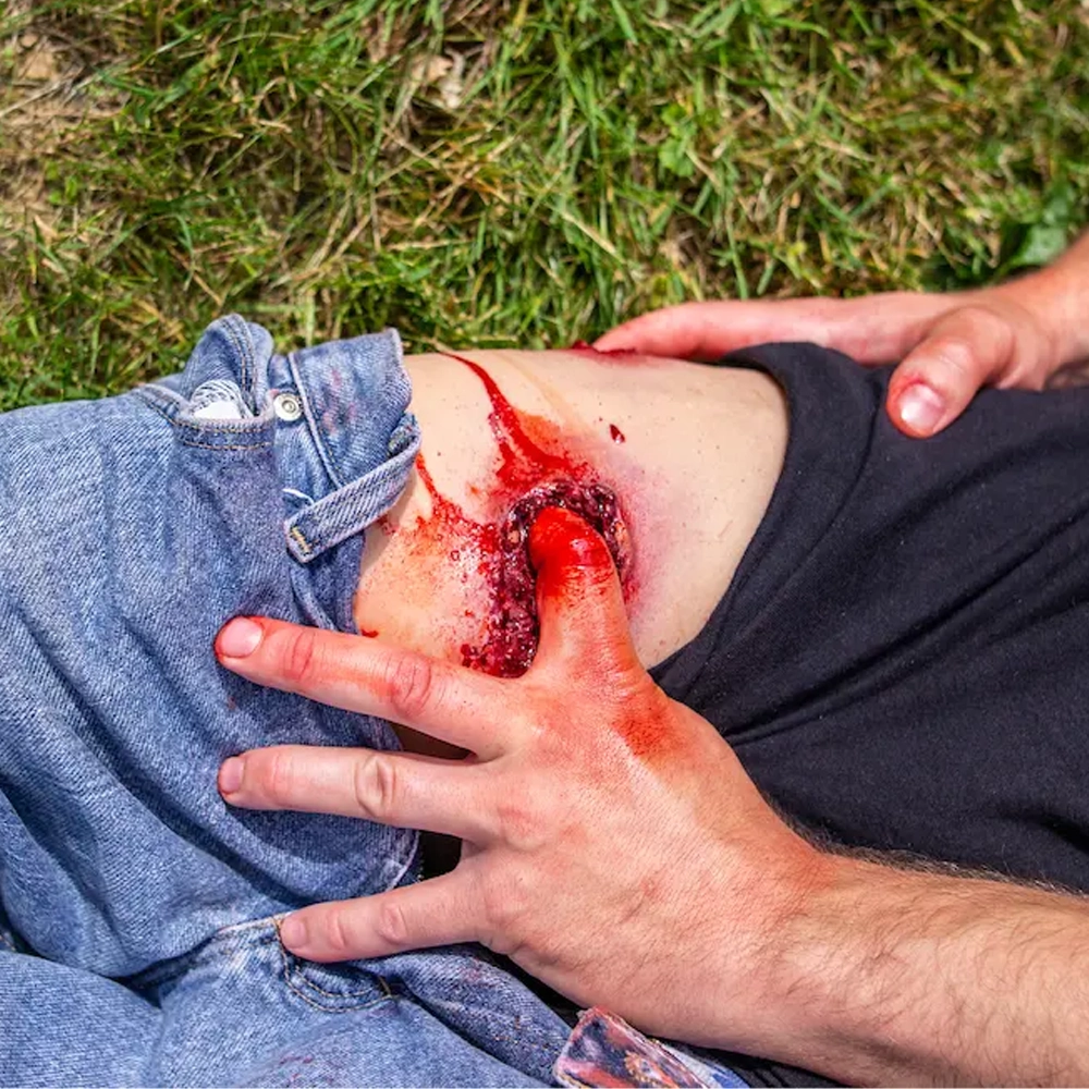 Gunshot wound (GSW) Leg 3 Gunshot wound (GSW) Leg - Image 3
