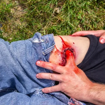 The GSW to Leg is a wearable simulation of a through-and-through gunshot wound to the thigh, exposing fat and muscle. It features a packable wound channel, integrated blood tubing, and a secure wrap design for immersive hemorrhage control training. - SÅR-WW3-010