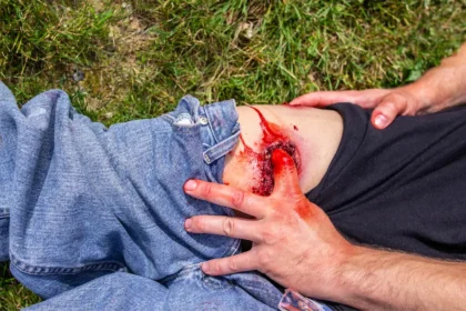 Gunshot wound (GSW) Leg - Image 3