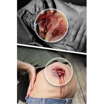 The Gun Shot Wound Male Groin is a wearable, high-fidelity male groin gunshot wound simulator featuring exposed anatomy and dual bleeding sites. Designed for use with the included blood supply pump or SKEDCO® systems, it enables realistic training in junctional hemorrhage control techniques. - SÅR-WW3-055