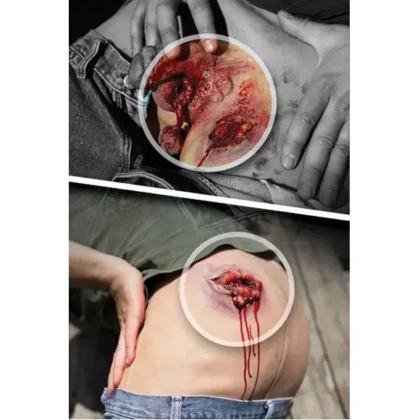 Gun Shot Wound Male Groin - Image 4