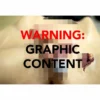 Gun Shot Wound Male Groin