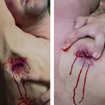 Shrapnel Wound Axillary (right)