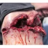Gunshot Wound Bicep
