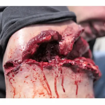 Gunshot Wound Bicep