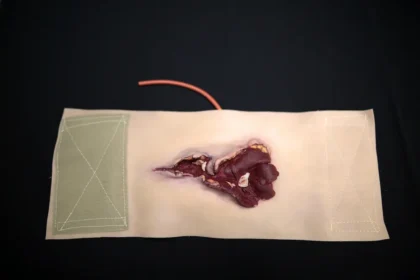 Gunshot Wound Bicep - Image 2
