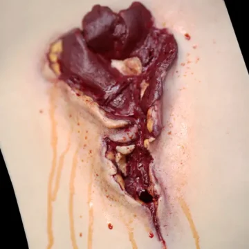 The Gunshot Wound Bicep is a wearable, high-fidelity trauma simulator depicting a high-velocity gunshot injury with exposed fat, muscle, bone, and tendons. Designed for bleeding control training, it includes a blood supply system and secures easily to actors or manikins. - SÅR-WW3-908