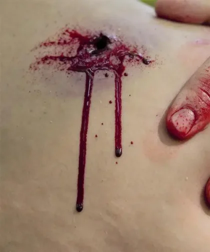 Gunshot Wound Clavicle (Right) - Image 5