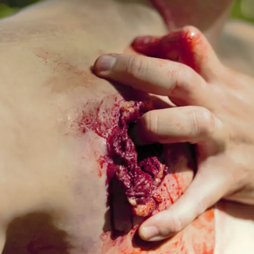 Gunshot Wound Clavicle (Right) 6 Gunshot Wound Clavicle (Right) - Image 6