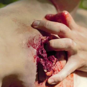 The Gunshot Wound Clavicle (Right) is a wearable simulation of a through-and-through gunshot injury, exposing fat, muscle, bone, and tendons. Featuring packable entry and exit wounds, it includes a bleeding system and provides realistic crepitus sensation for enhanced training. - SÅR-WW3-909