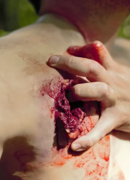 Gunshot Wound Clavicle (Right) - Image 6