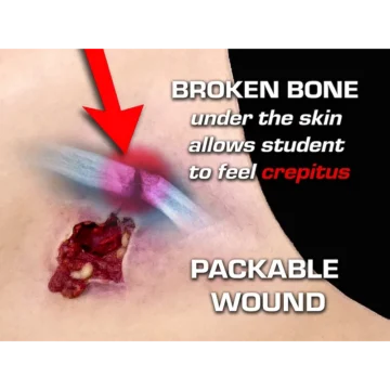 Gunshot Wound Clavicle (Right) 13 Gunshot Wound Clavicle (Right) - Image 7