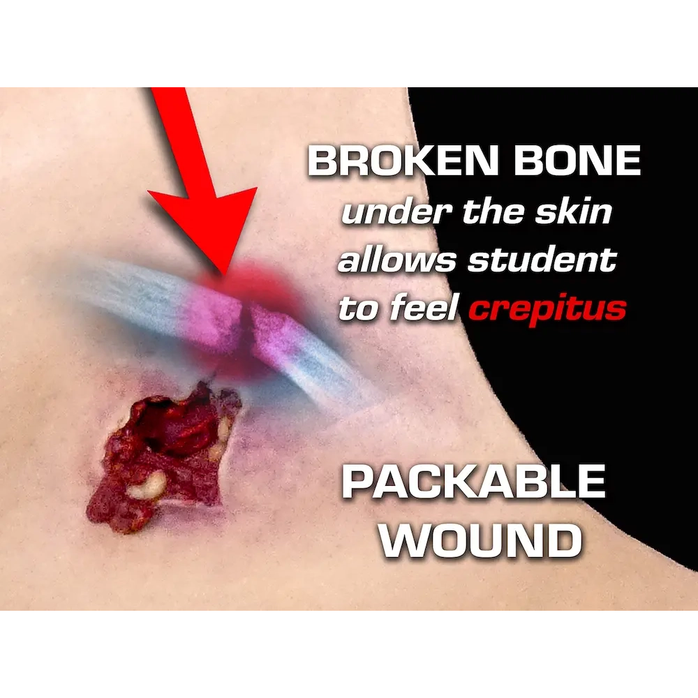 Gunshot Wound Clavicle (Right) 7 Gunshot Wound Clavicle (Right) - Image 7