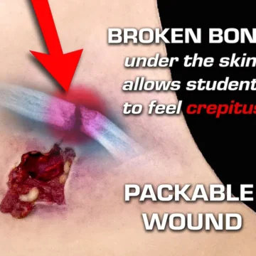 The Gunshot Wound Clavicle (Right) is a wearable simulation of a through-and-through gunshot injury, exposing fat, muscle, bone, and tendons. Featuring packable entry and exit wounds, it includes a bleeding system and provides realistic crepitus sensation for enhanced training. - SÅR-WW3-909
