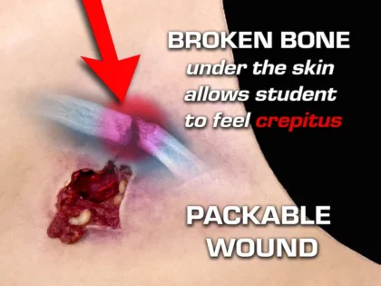 Gunshot Wound Clavicle (Right) - Image 7