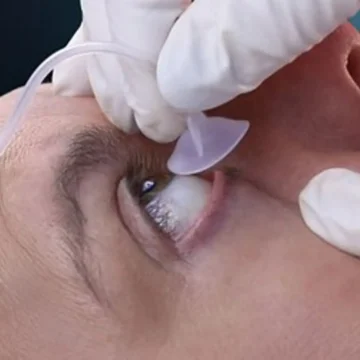 The Morgan Medi-Flow Lens is an ocular irrigation device designed to deliver continuous flow of solution to the eye for effective flushing in emergency care. It supports rapid and hands-free irrigation without direct contact with the cornea. - EE-00028
